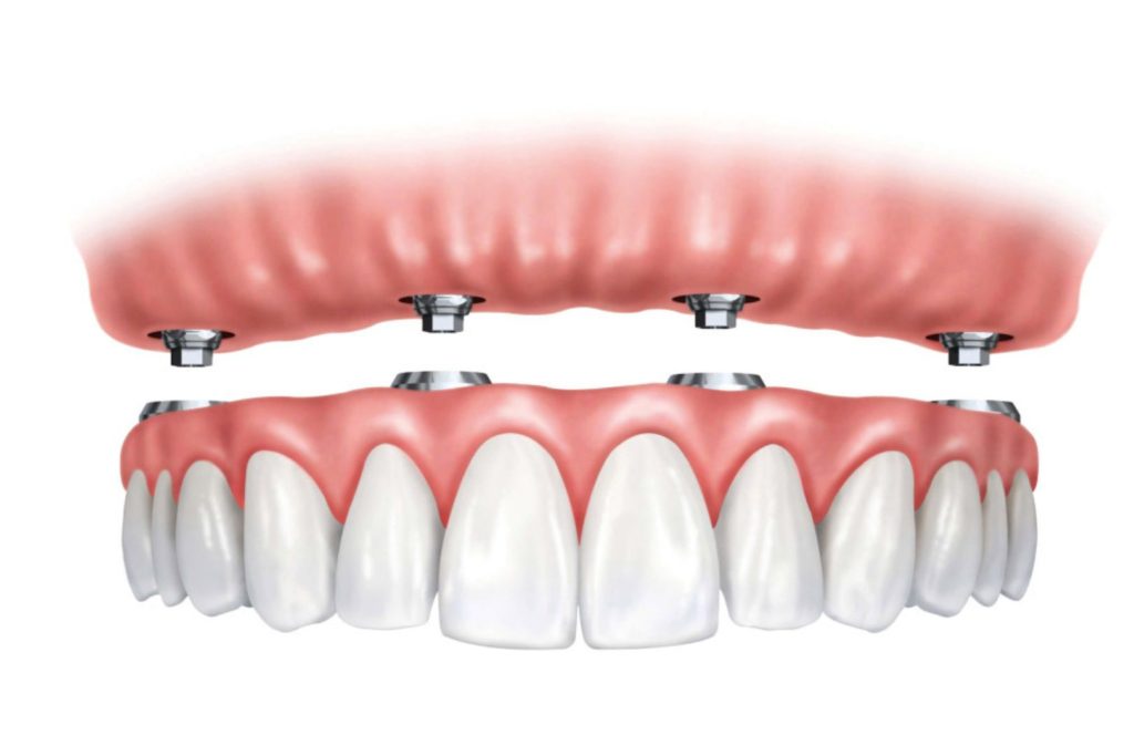Model All-on-4 implantata.