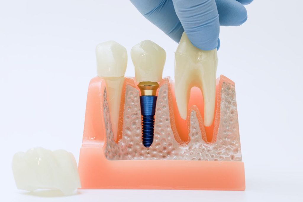 Plastični model koji prikazuje kako izgleda implantat, a kako prirodan zub jedan do drugog kada su u zubnom mesu.