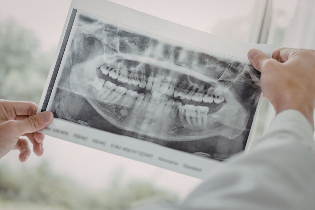 ruke stomatologa koje drže 3d snimku čeljusti - takva snimka pomaže u planiranju terapije i određivanju tko je kandidat za zero bone solution zahvat