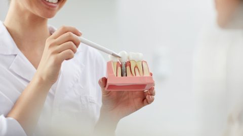 Zubni implantati: mitovi i istine
